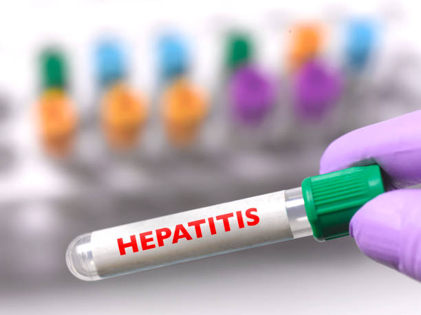 Hepatitis A