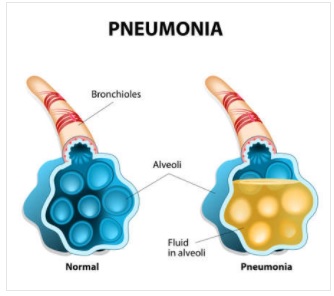 Types Of Pneumonia