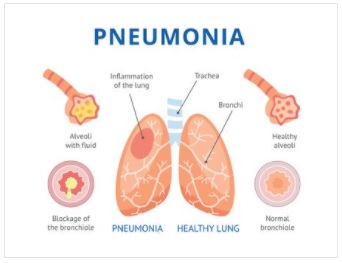 pneumonia