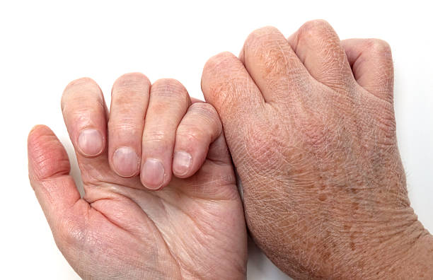 woman's hands, showing very dry skin and damaged cuticles.