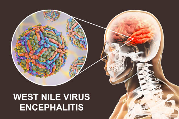 Encephalitis caused by West Nile virus