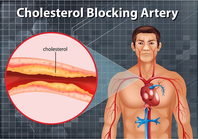 cholesterol blocking artery in human body 